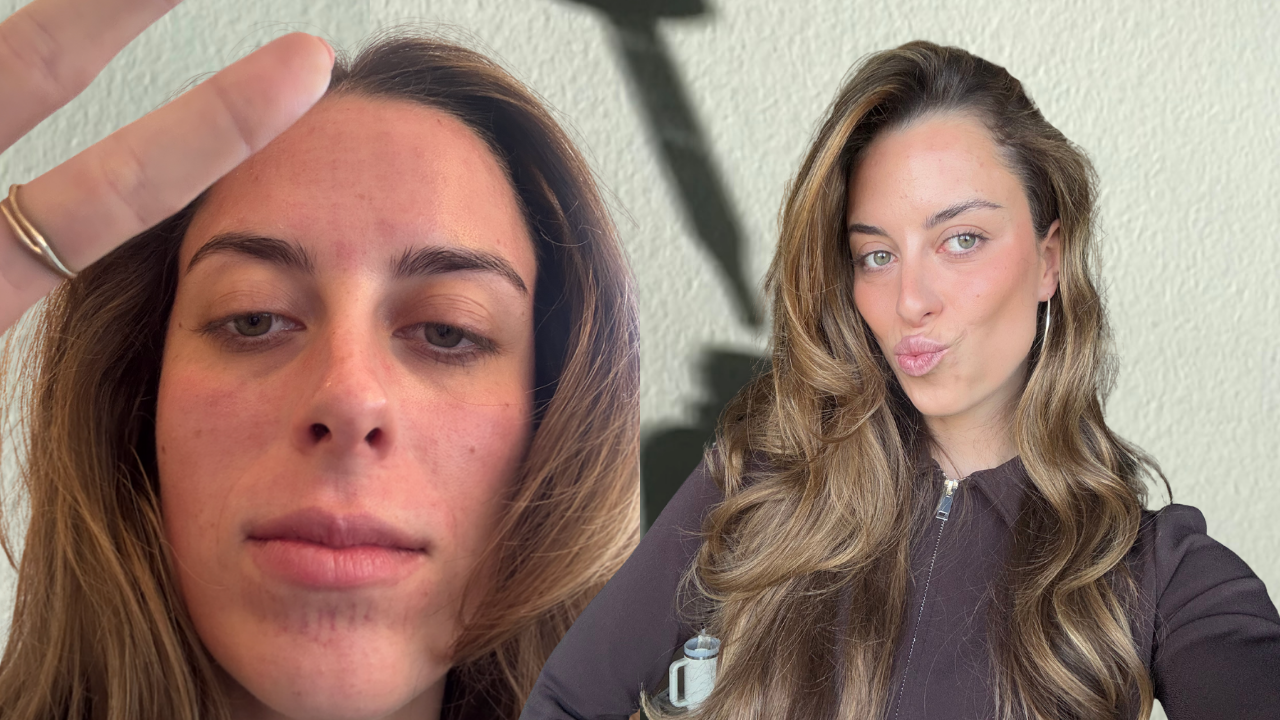 microneedling ervaring